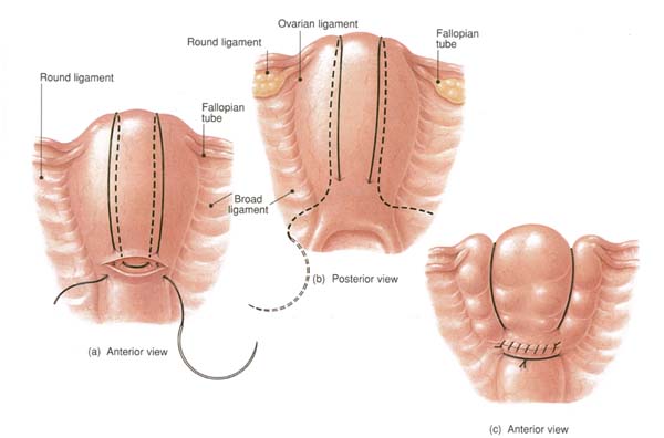Varice ale arterelor uterine ascendente și ale arterelor ovariene pe ambele părți